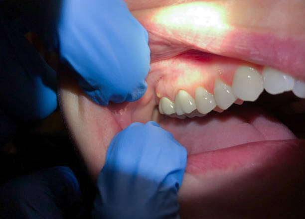 Best Emergency Treatment for Dental Infections or Abscesses in Zeigler, IL